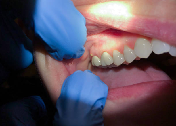 Tooth Infection Emergency Dentist in CA