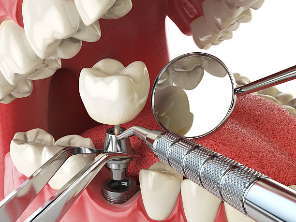 Best Cracked Tooth Emergency Dentist  in Squaw Valley, CA